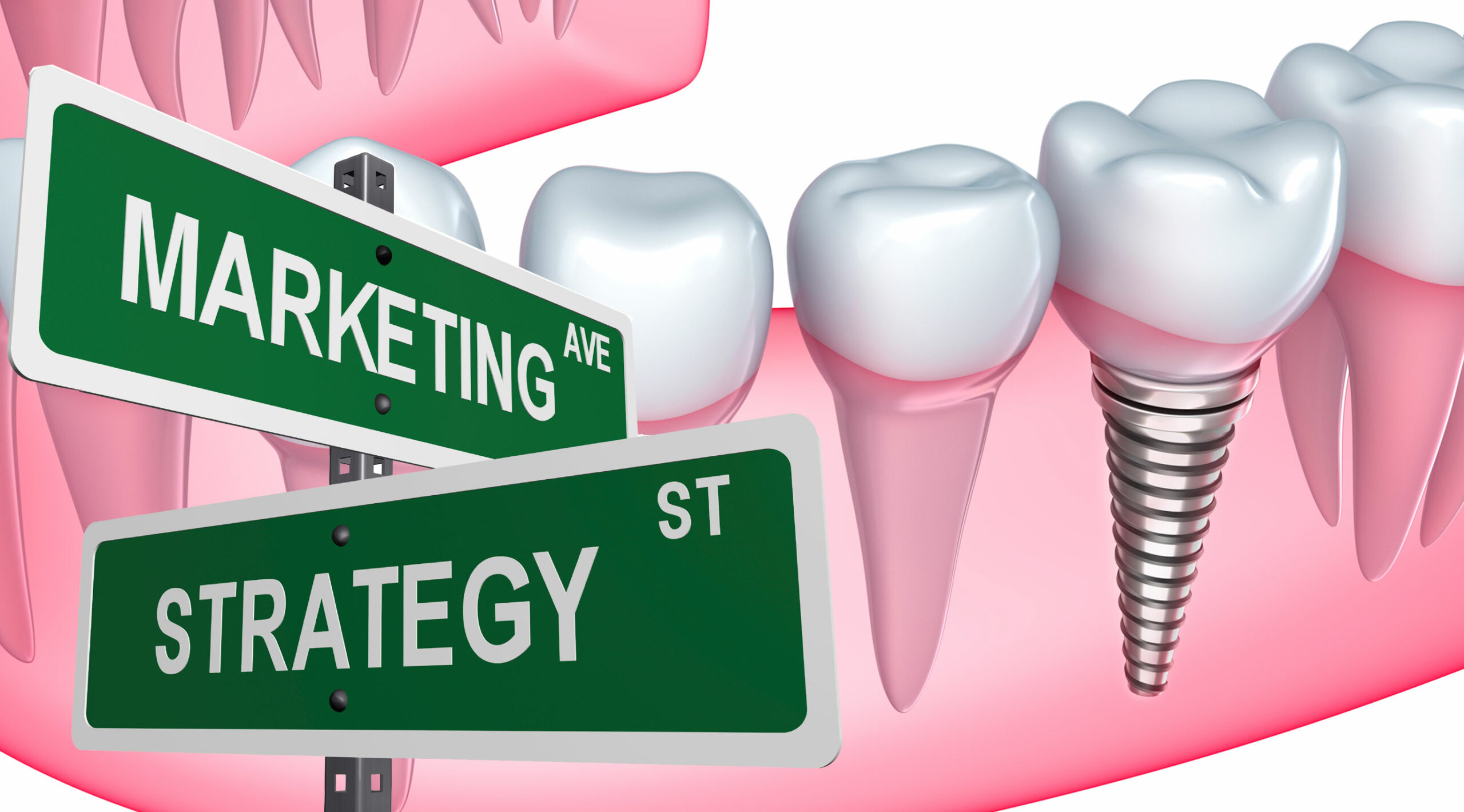 El Precio de los Implantes Dentales: Todo lo que NO sabes