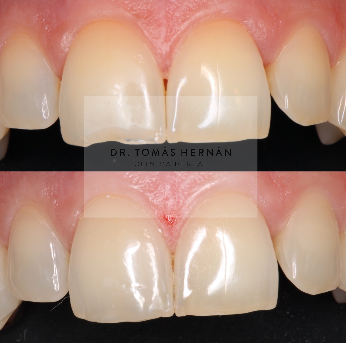 Fractura Dental Tratamiento