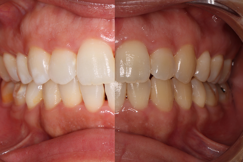 Blanqueamiento Dental: ¿Qué debo saber?