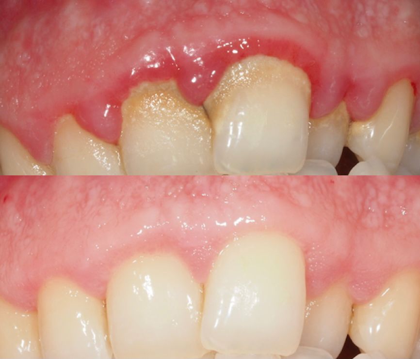 ¿Qúe es la Enfermedad Periodontal?