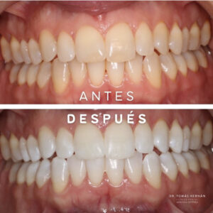 Aspectos Básicos del Blanqueamiento Dental