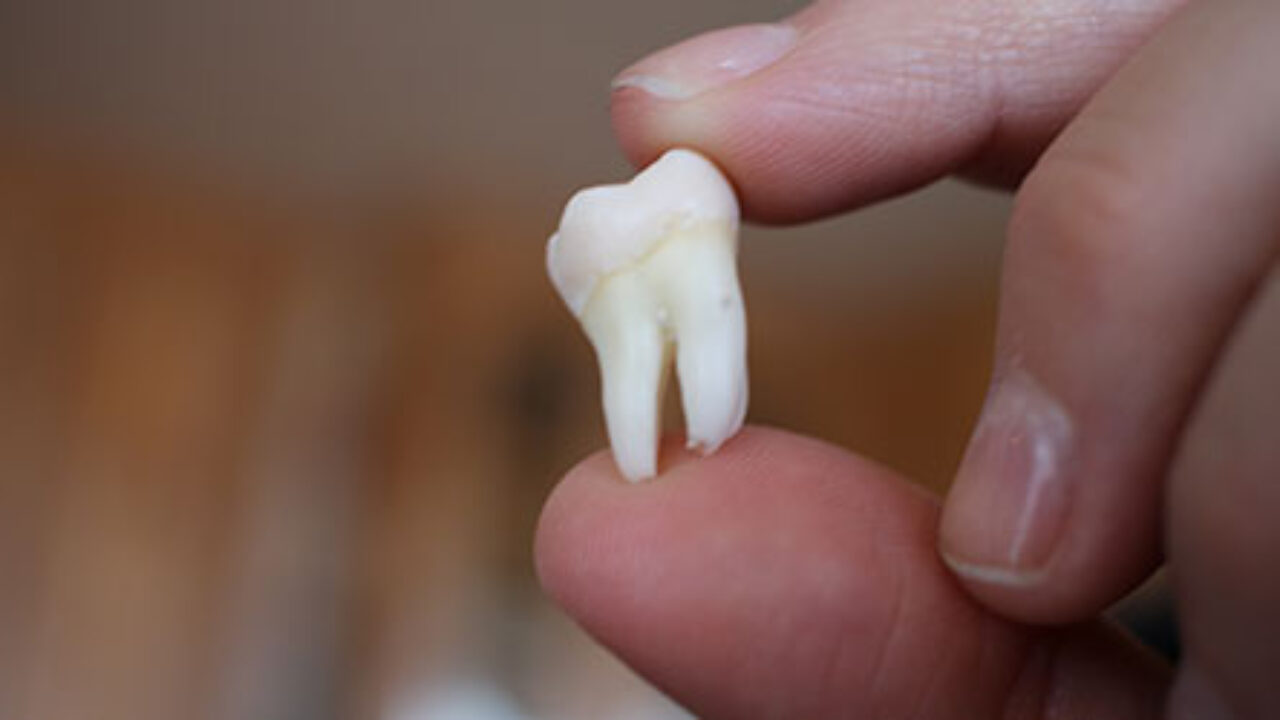 Extracción de las Muelas del Juicio