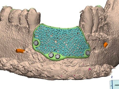 Regeneración Ósea en Odontología