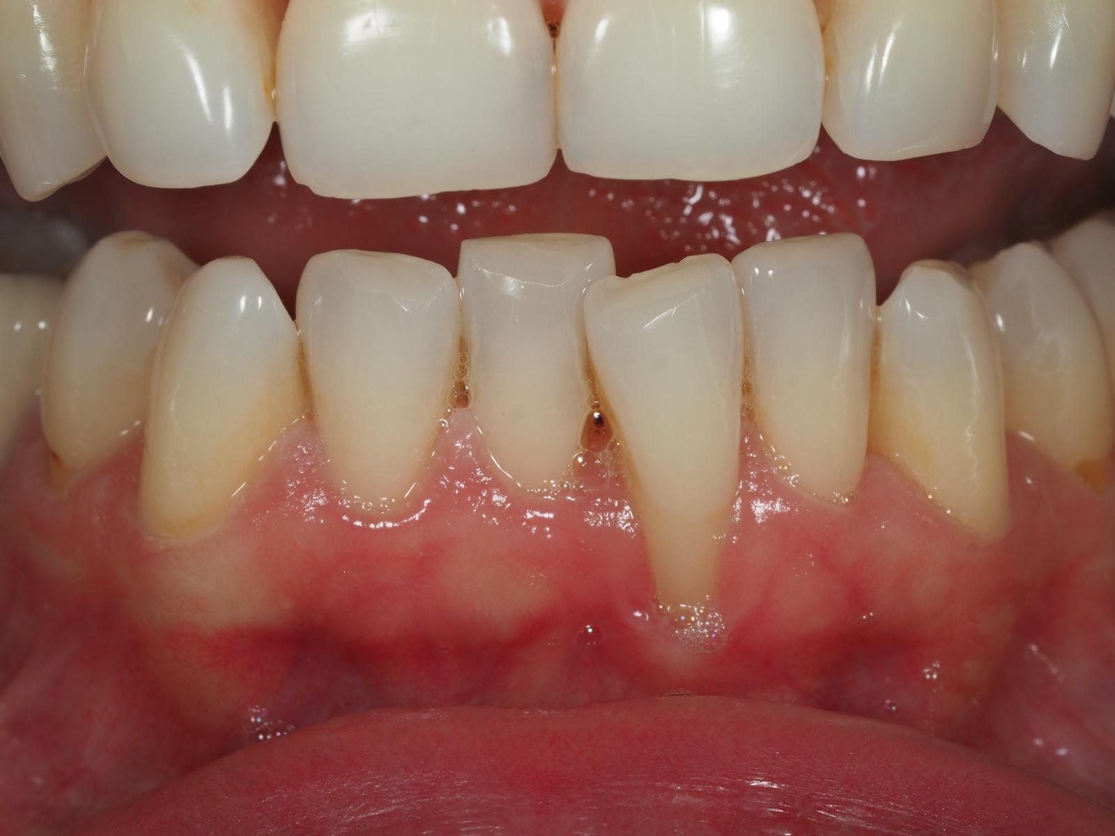 Recesión Gingival Madrid